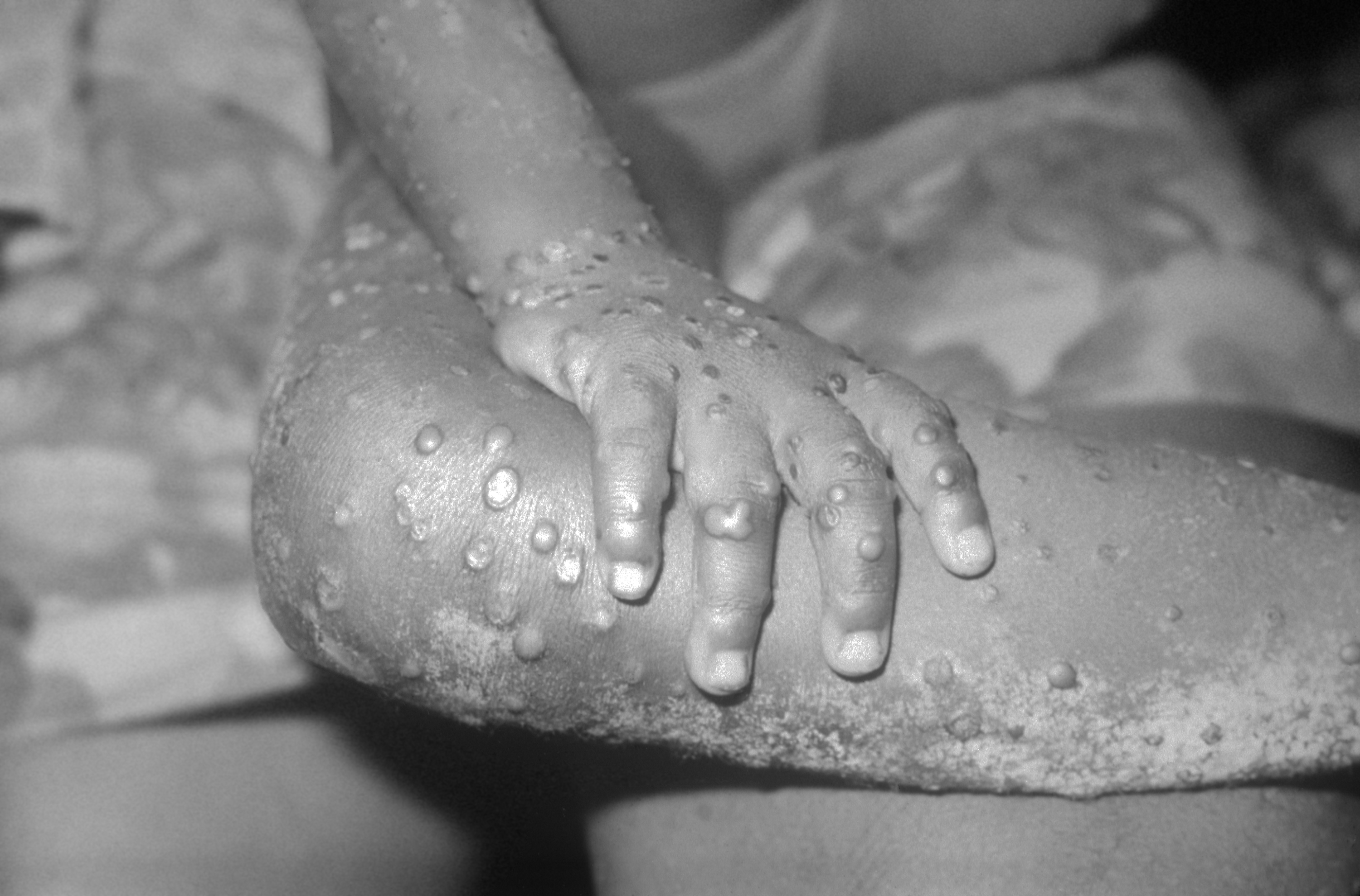 Wikimedia The symptoms last up to five weeks.